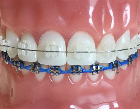 metal or ceramic brackets|problems with ceramic braces.